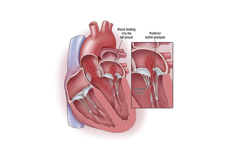 Minimal İnvaziv Mitral Kapak Tamiri